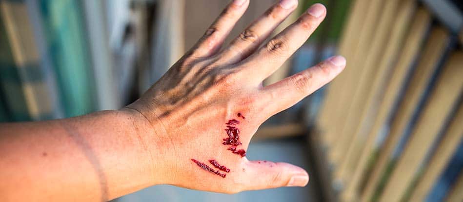 Person with bloodied hand